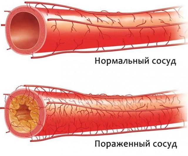 Артериальная гипертензия